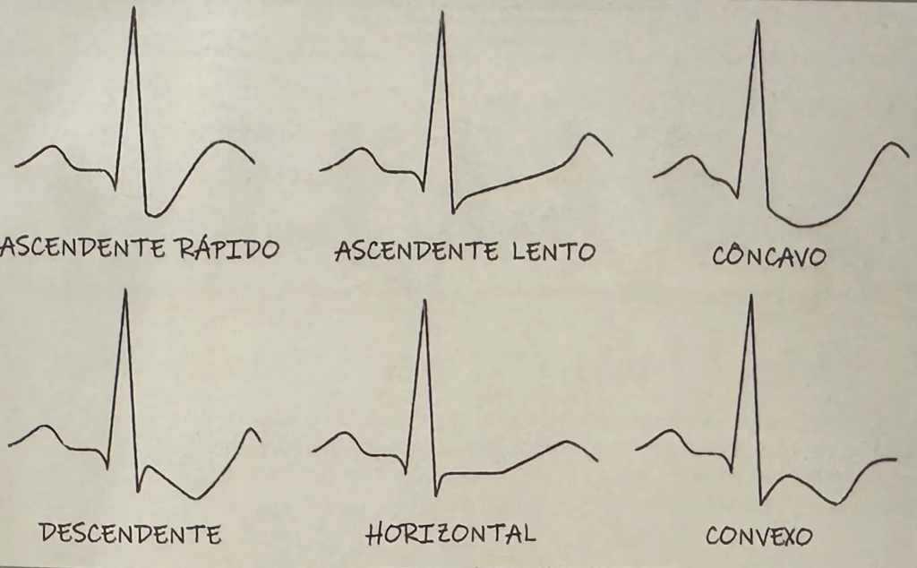 Ilustração mostrando diferentes morfologias do segmento ST no eletrocardiograma: ascendente rápido, ascendente lento, côncavo, descendente, horizontal e convexo, presente no livro de Leonardo Felipe Benedeti Marinucci.